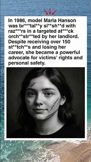 150 St*t*hes: The Night Marla Hanson’s Life Changed Forever #shorts #facts #history #historyfacts