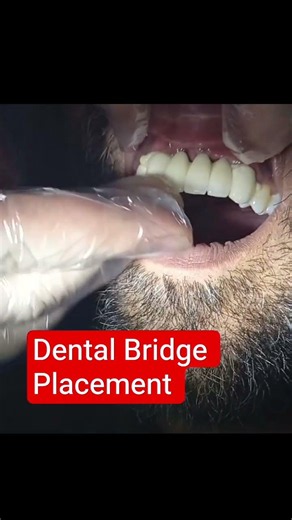 Anterior Dental Bridge Placement #dentist #teethdecay #dentalclinic #dentalcare #dentistry