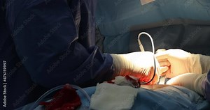 Open heart surgery with different surgical tubes connected to a coronary artery bypass heart close up