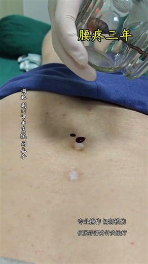 Ease Your Lower Back Pain: Acupuncture & Cupping Techniques Explained