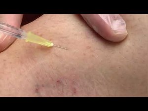 Treating Thread Veins with Microsclerotherapy 💉 | Simply Clinics