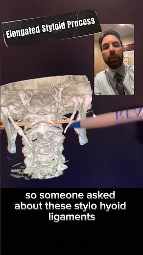 Elongated Styloid Process #chiropractic #cranberrytwp