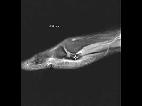 Sesamoid stress fracture and plantar plate injury foot