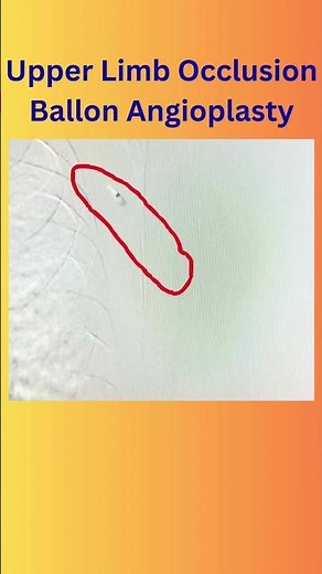 Upper Limb Occlusion Balloon Angioplasty: Minimally Invasive Arm Artery Blockage Treatment Explained