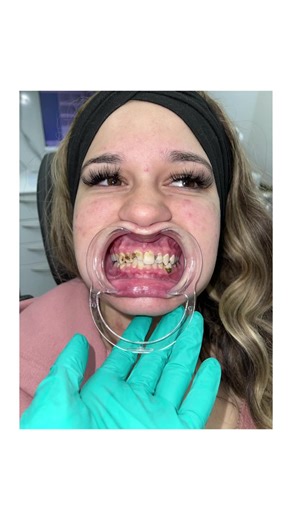 31K views · 216 reactions | Blayne was in an accident 6 months ago that left her teeth damaged. She finally had the courage to chose herself! So glad she did! #courage #accident #smileagain | Smile Again Dental - Texas | Facebook