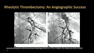 Rheolytic Thrombectomy