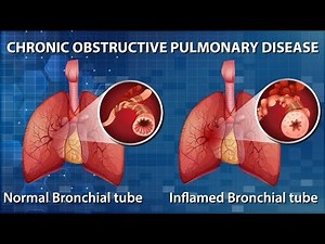 Breathe Easy in Understanding COPD (4 Minutes)