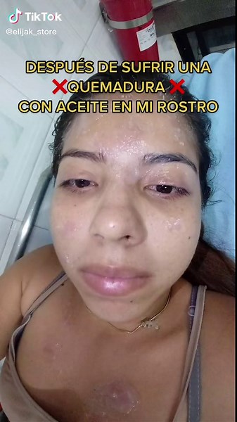 Cómo tratar quemaduras por tónico despigmentante y manchas de aceite en la piel