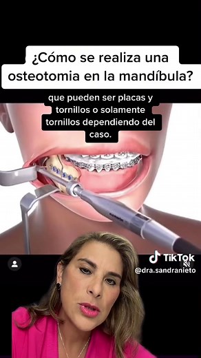 Cirugía Maxilofacial: Todo sobre Mandíbula y Osteotomía