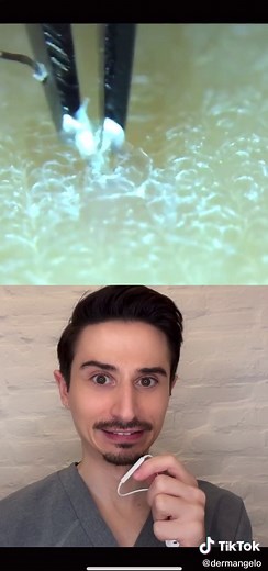 Dermatologist Reacts: How to Remove Ingrown Hair Safely