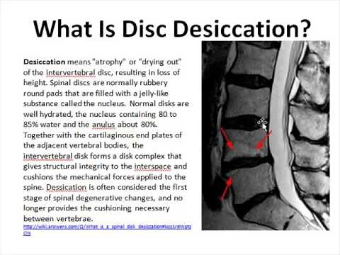 Disc Desiccation