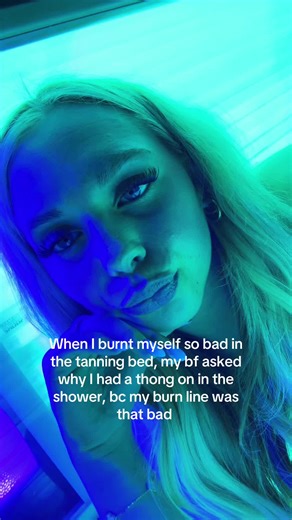 Severe Tanning Bed Burn: A Cautionary Tale