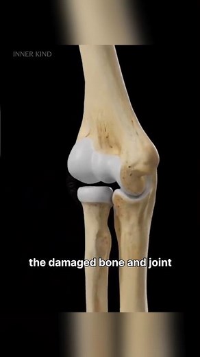 Elbow Replacement Surgery Explained In 3d animation