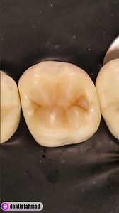 Create functional and anatomically-correct class 1 restorations!