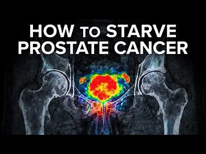 Prostate Cancer: What You NEED To Know