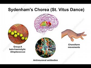 Sydenham Chorea or Rheumatic Chorea or St Vitus Dance ; Causes, Symptoms, Diagnosis, Treatment