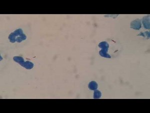 AFBs positive smear demonstration