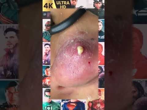 Blackheads Removal #561 | Acne Treatment and Very Satisfying Satisfying Pimple pop #blackheads