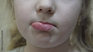 a swollen lip in a child, bee sting, little girl with swollen lip, lip after after anesthesia