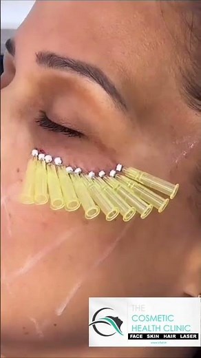 *"Threads treatment under the eye"* likely refers to a cosmetic procedure called a *thread lift*