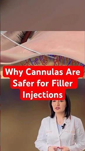 Why Cannulas Are Safer for Filler Injections