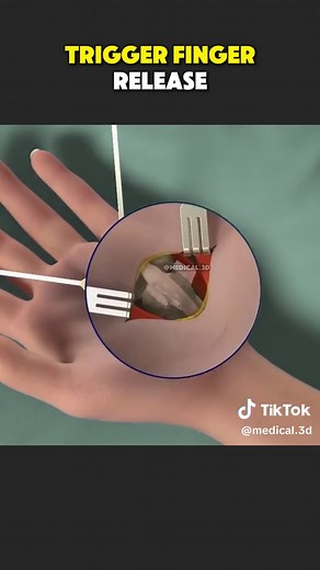 Trigger Finger Release Surgery (3D Animation) #triggerfinger #triggerfingerrelease #triggerfingersurgery #fingersurgery #triggerfinger?