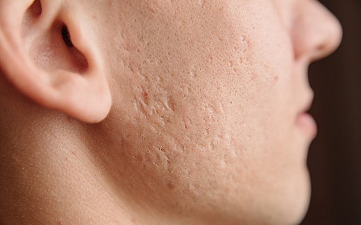 How To Get Rid Of Acne Scars   How Long Does It Take To Fade