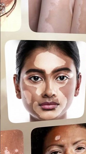 Tratamiento para el Vitiligo