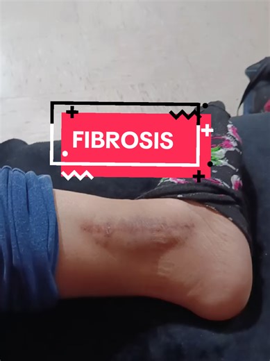 What is Fibrosis? Understanding Ankle Fibrosis