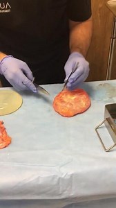 Capsule cutting-calcification and silicone rupture