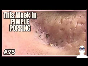 This Week In PIMPLE POPPING #75