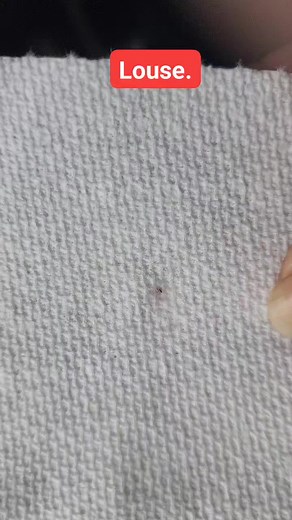 10K views · 31 reactions | Head Louse: A small wingless parasitic insect that lives on the head. Louse is the singular form of Lice. #facts #factsoflice #Lice #liceremoval #louse | LRS - Lice Removal Service | Facebook