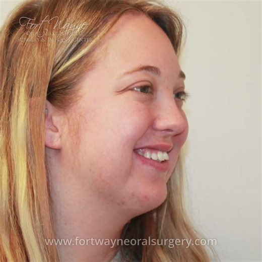 Stephanie’s Life Transformation. Another VSP CT-Guided Orthognathic DBL Jaw Surgery case.