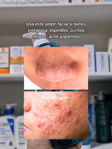 Effaclar Micro-exfoliante: Solución para Piel con Acné