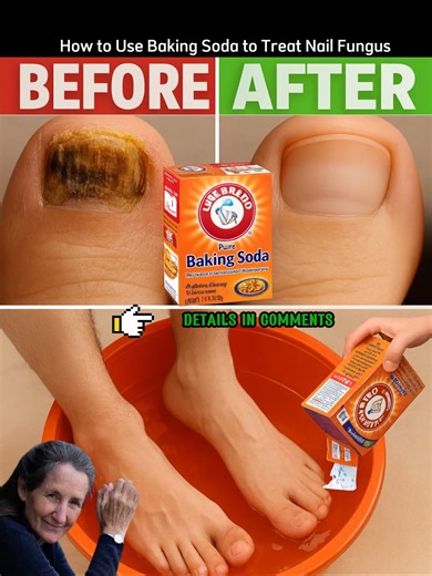 How to Use Baking Soda to Treat Nail Fungus 👇👇👇 | Pure Path Health