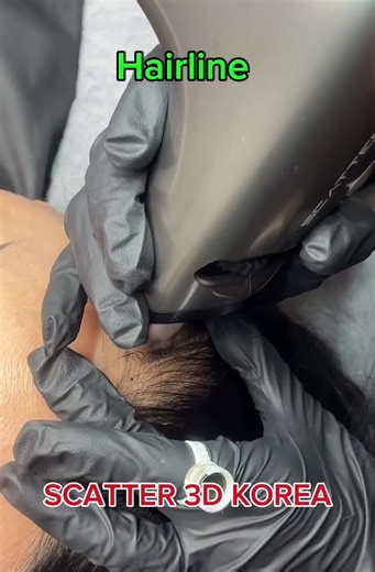 SCATTER SMP Device Tutorial: Female Hairline Procedure Workflow#SCATTER#SMPdevice#HairlineTechnique