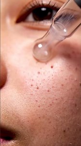 Sebaceous Filament Removal ASMR | Extreme Close-Up #blackheadcaique #blackheadremoval #cleanskin