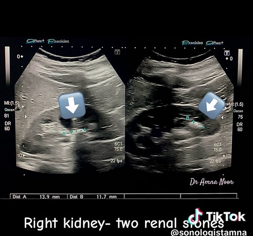 Ultrasound findings reveal a right renal calculus with moderate hydronephrosis – a classic presentation of obstructive uropathy. Early diagnosis is key to preventing long-term renal damage. 📌 Modality: Ultrasound 🧠 Key Finding: Hyperechoic focus with posterior acoustic shadowing dilated pelvicalyceal system 🔍 Diagnosis: Right renal stone with moderate hydronephrosis Always correlate clinically and with renal function tests. 📍#SonologistPerspective #UltrasoundCases #RenalCalculus #Hydronephro