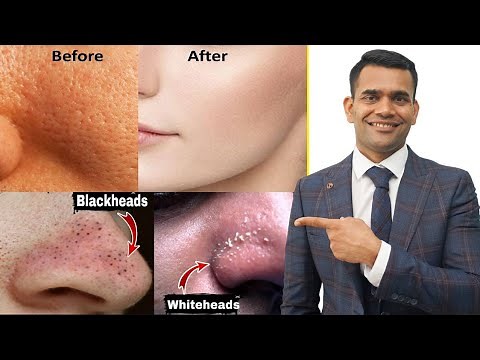 Blackheads, Whiteheads, Open Pores 100 % Working Home Remedy | How To Shrink Pores