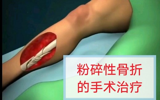 医学科普：胫骨粉碎性骨折的治疗