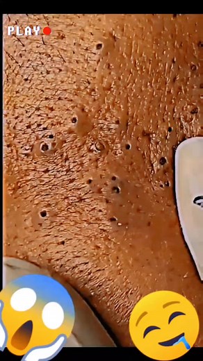 💥🤩 Dr. Sarisfaction 🤩💥 Watch Me Pop The Biggest Blackheads and Pimples Ever 🎥 🚀✨ You Won’t Believe The Results 😱 Like, Comment and Share If You Enjoyed This Video 💖 Follow Me For More Amazing Extractions 🔥 #skincare #beauty #pimplepopping #blackheadremoval #whiteheadremoval #zits #acne #skin #selfcare #satisfying #asmr #pimple #pimples #acneremoval #cyst #blackhead #whitehead #blemish #zit #rosacea #eczema #psoriasis #skincareroutine #skincaretips #skincareaddict #selfcare #satisfying #