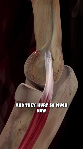 514K views · 5K reactions | Don't get this wrong! Tennis elbow explained like we're 8yo. Massage will help but you can make it worse. It will take time and a lot longer than what you think. Persistence and patience is needed and it can feel like months has gone by before it starts to feel better. | Melt: Massage for Couples | Facebook