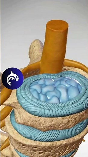 See a 3D view of a Cervical Disc Bulge | 3D Medical Animation