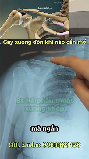 Gãy Xương Đòn Khi Nào Cần Mổ