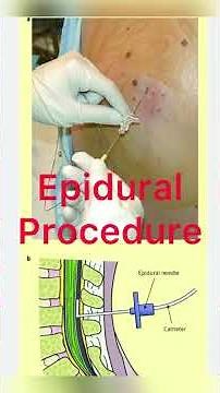 Epidural Catheter || Epidural Anesthesia Removal | Lumber Epidural Removal | Dr Raj #doctor #shorts