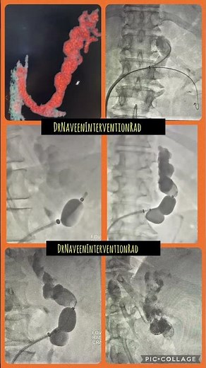 Another case of BRTO.Gastric variceal bleed, intervention radiology management