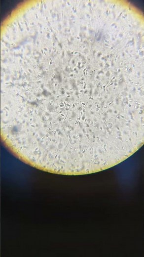semen analysis (sperms in microscope 🔬)