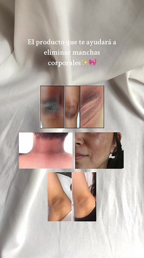 Quién no ama el ácido glicólico?🥹🤍 Ideal para mejorar la pigmentación de zonas del cuerpo y de la cara ya que exfolia suavemente la piel acelerando la renovación celular o sea haciendo que la piel muerta salga mas rápido por lo tanto se regenere mas rapido✨ Úsalo de 2-3 veces por semana solo en la noche y muchoooo protector solar en las zonas expuesta en el día #acidoglicolico #hiperpigmentacion #manchascorporales #manchas #glycolicacid #manchasenlapiel #skincare101 #ecuador #manchasenlacara #