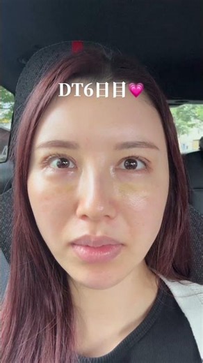 眼瞼下垂(切開法)のダウンタイムを1週間分まとめました #眼瞼下垂 #眉下リフト #ダウンタイム