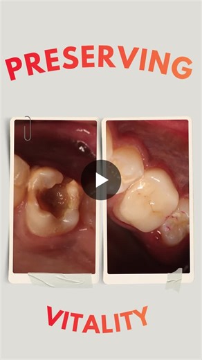 Preserving pulp vitality is extremely important to enhance the life span of a tooth. In this case a Direct pulp capping was done with White MTA followed by strengthening of weakened cusps by a Bonded… | Muhammad Hamdan